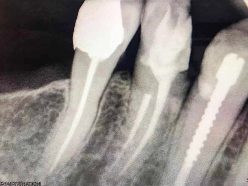 https://www.lingchendental.com/high-resolution-cmos-digital-dental-x-ray-sensor-product/
