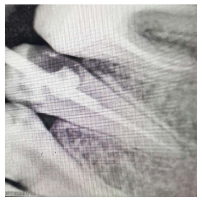 portable dental x ray unit-2